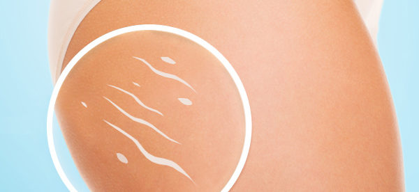 inestetismi della cellulite inestetismi della cellulite