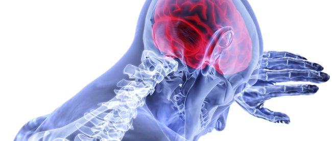 Ictus-cause-sintomi-e-rimedi Ictus: le cause